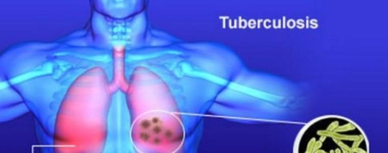 Два пъти повече мъже заболяват от туберкулоза в сравнение с жените