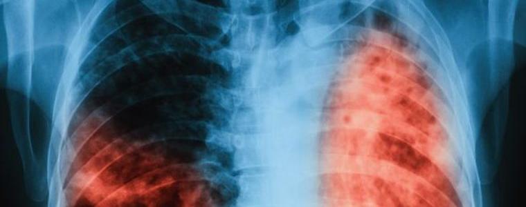 Седмица на отворените врати за прегледи за туберкулоза ще се проведе добричката болница