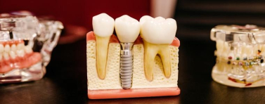 Какво трябва да знаем за зъбните импланти