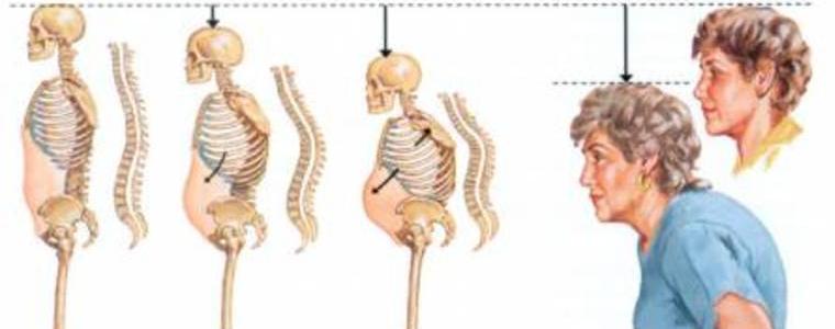 20 октомври - Световен ден за борба с остеопорозата