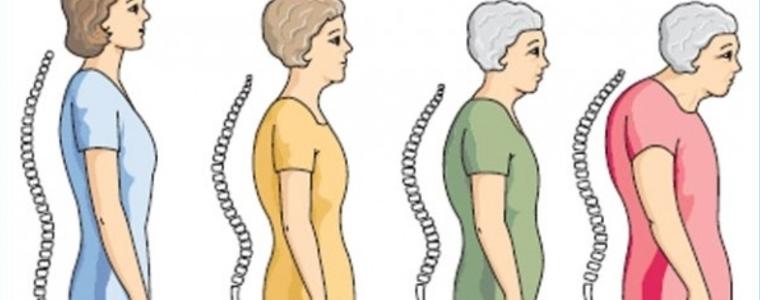 Информационно събитие за борба с остеопорозата ще се проведе в Добрич