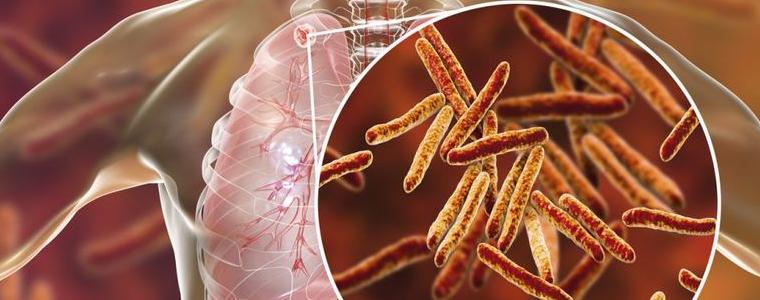 Кампания срещу туберкулозата в Добрич: Шанс за ранна диагностика до 27 март (ЧУЙТЕ)