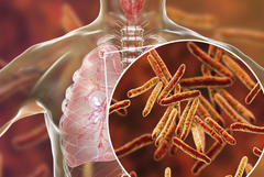 Кампания срещу туберкулозата в Добрич: Шанс за ранна диагностика до 27 март (ЧУЙТЕ)